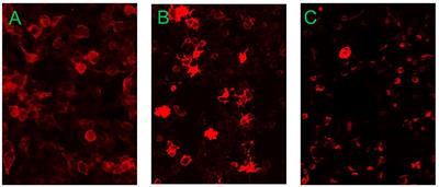 Case report: Autoimmune glial fibrillary acidic protein astrocytopathy with overlapping autoimmune syndrome